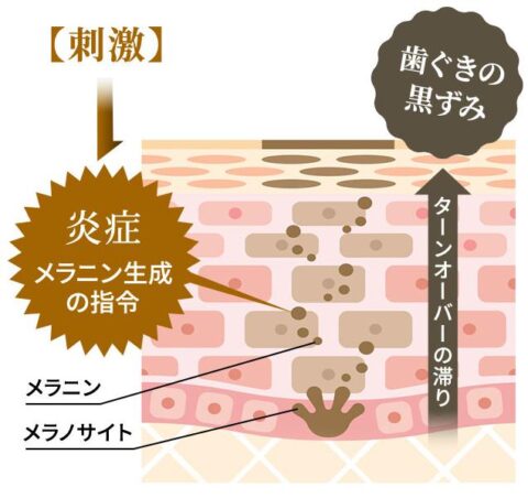 歯茎 黒ずみ