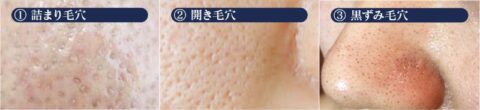 毛穴