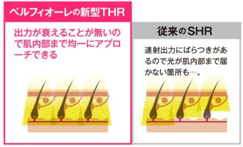 THR脱毛