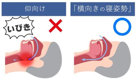 いびき 気道