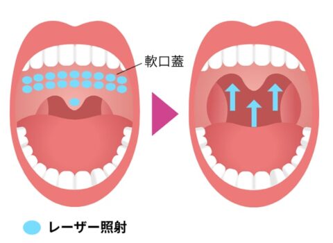 ナイトノーズ