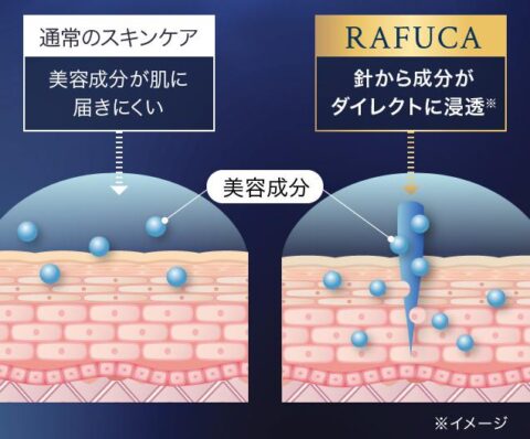 マイクロニードル スピキュール